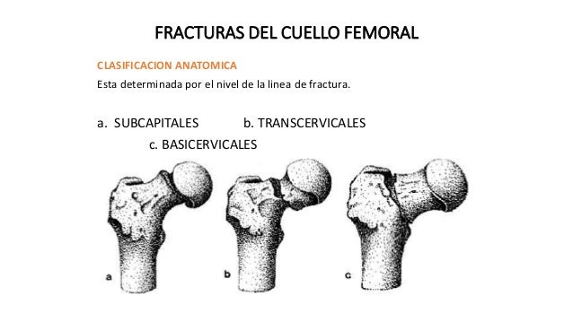 caso clinico de fractura de cuello de femur pdf