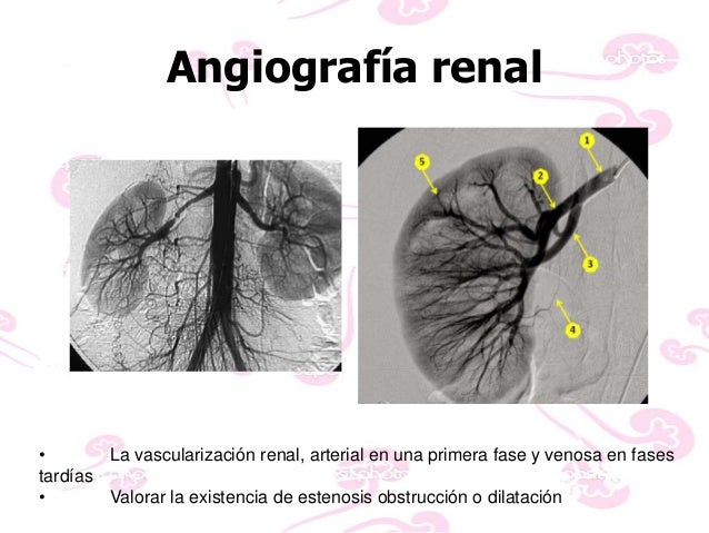 angiografia por sustraccion digital pdf