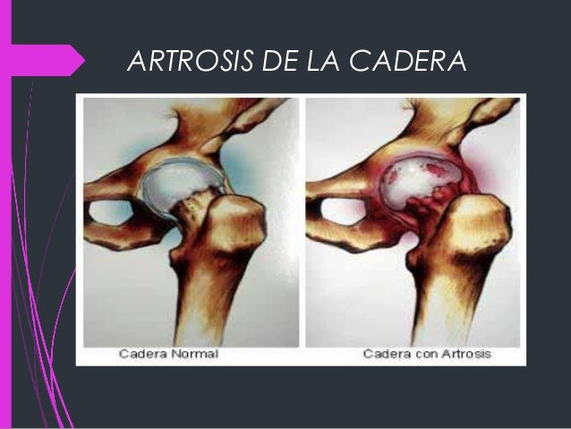artrosis y ejercicio fisico pdf